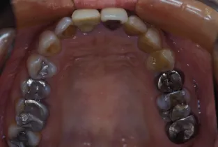 歯の移植の症例