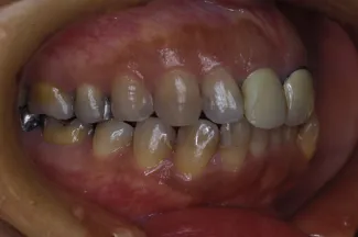 歯の移植の症例