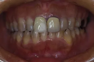 歯の移植の症例