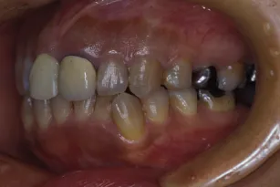 歯の移植の症例