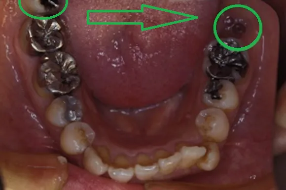 歯の移植の症例