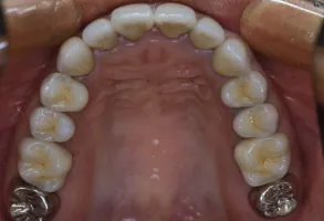 歯の移植の症例