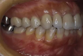 歯の移植の症例