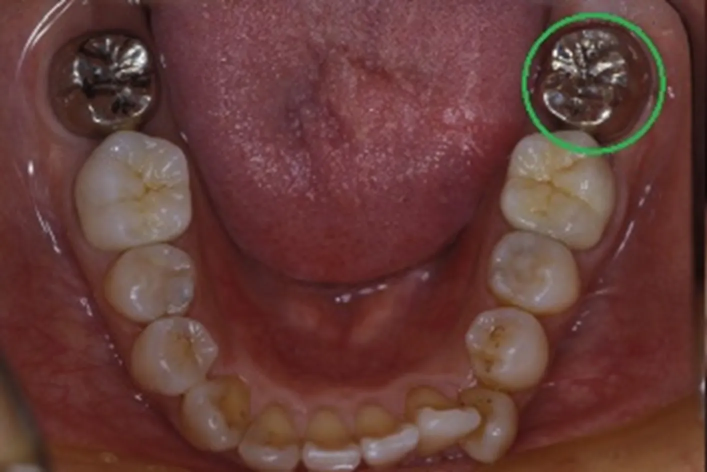 歯の移植の症例