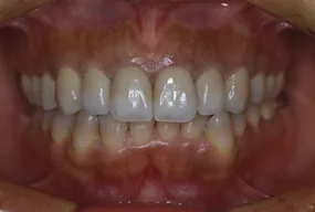 歯の移植の症例